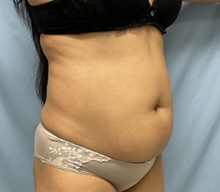 Liposuction Before Photo by Julia Spears, MD, FACS; Marlton, NJ - Case 46549