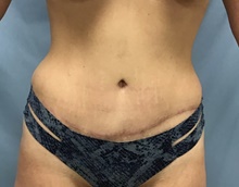 Panniculectomy After Photo by Julia Spears, MD, FACS; Marlton, NJ - Case 46554