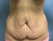 Panniculectomy Before Photo by Julia Spears, MD, FACS; Marlton, NJ - Case 46554