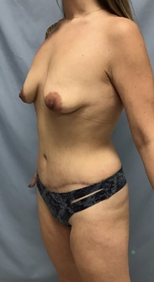 Panniculectomy After Photo by Julia Spears, MD, FACS; Marlton, NJ - Case 46554