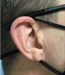 Ear Reconstruction Surgery After Photo by Julia Spears, MD, FACS; Marlton, NJ - Case 46566