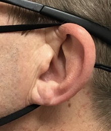 Ear Reconstruction Surgery After Photo by Julia Spears, MD, FACS; Marlton, NJ - Case 46566