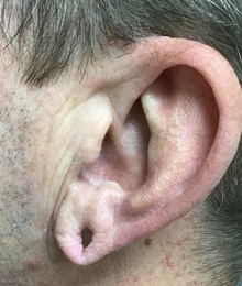 Ear Reconstruction Surgery Before Photo by Julia Spears, MD, FACS; Marlton, NJ - Case 46566
