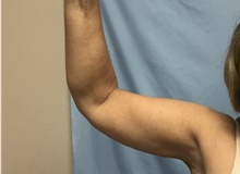 Arm Lift After Photo by Julia Spears, MD, FACS; Marlton, NJ - Case 46567