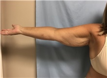 Arm Lift Before Photo by Julia Spears, MD, FACS; Marlton, NJ - Case 46567