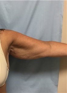 Arm Lift Before Photo by Julia Spears, MD, FACS; Marlton, NJ - Case 46567