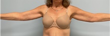 Arm Lift After Photo by Julia Spears, MD, FACS; Marlton, NJ - Case 46632