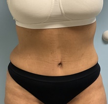 Panniculectomy After Photo by Julia Spears, MD, FACS; Marlton, NJ - Case 46633