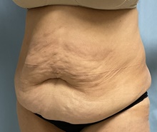 Panniculectomy Before Photo by Julia Spears, MD, FACS; Marlton, NJ - Case 46633
