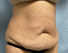 Panniculectomy Before Photo by Julia Spears, MD, FACS; Marlton, NJ - Case 46633