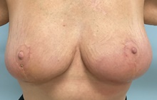 Breast Reduction After Photo by Julia Spears, MD, FACS; Marlton, NJ - Case 46634