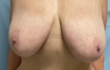 Breast Reduction Before Photo by Julia Spears, MD, FACS; Marlton, NJ - Case 46634