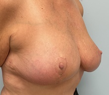 Breast Reduction After Photo by Julia Spears, MD, FACS; Marlton, NJ - Case 46634