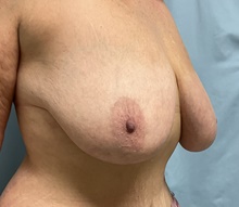 Breast Reduction Before Photo by Julia Spears, MD, FACS; Marlton, NJ - Case 46634