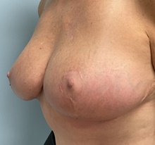 Breast Reduction After Photo by Julia Spears, MD, FACS; Marlton, NJ - Case 46634