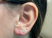 Ear Surgery After Photo by Julia Spears, MD, FACS; Marlton, NJ - Case 46911