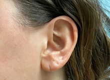 Ear Surgery Before Photo by Julia Spears, MD, FACS; Marlton, NJ - Case 46911