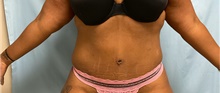 Tummy Tuck After Photo by Julia Spears, MD, FACS; Marlton, NJ - Case 46913