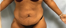 Tummy Tuck Before Photo by Julia Spears, MD, FACS; Marlton, NJ - Case 46913