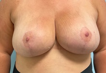Breast Reduction After Photo by Julia Spears, MD, FACS; Marlton, NJ - Case 47577