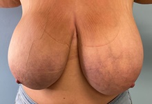 Breast Reduction Before Photo by Julia Spears, MD, FACS; Marlton, NJ - Case 47577