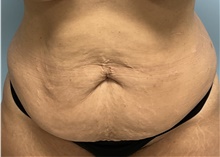 Tummy Tuck Before Photo by Julia Spears, MD, FACS; Marlton, NJ - Case 47751
