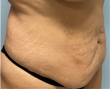 Tummy Tuck Before Photo by Julia Spears, MD, FACS; Marlton, NJ - Case 47751