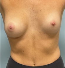 Breast Augmentation Before Photo by Julia Spears, MD, FACS; Marlton, NJ - Case 47752