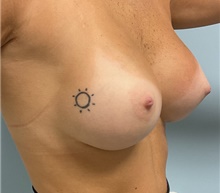 Breast Augmentation After Photo by Julia Spears, MD, FACS; Marlton, NJ - Case 47752