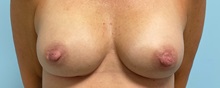Breast Augmentation After Photo by Julia Spears, MD, FACS; ,  - Case 50282