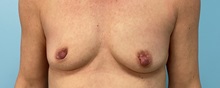Breast Augmentation Before Photo by Julia Spears, MD, FACS; ,  - Case 50282