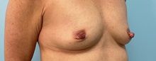Breast Augmentation Before Photo by Julia Spears, MD, FACS; ,  - Case 50282