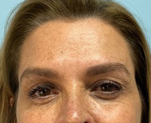 Botulinum Toxin After Photo by Julia Spears, MD, FACS; ,  - Case 50283