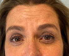 Botulinum Toxin Before Photo by Julia Spears, MD, FACS; ,  - Case 50283