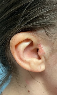 Wound Care After Photo by Julia Spears, MD, FACS; ,  - Case 50319