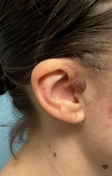 Wound Care Before Photo by Julia Spears, MD, FACS; ,  - Case 50319