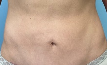 Tummy Tuck After Photo by Julia Spears, MD, FACS; ,  - Case 50320
