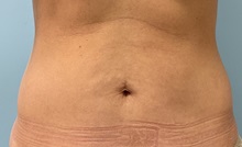 Tummy Tuck Before Photo by Julia Spears, MD, FACS; ,  - Case 50320