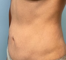 Tummy Tuck After Photo by Julia Spears, MD, FACS; ,  - Case 50320