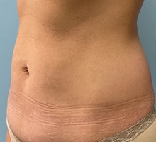 Tummy Tuck Before Photo by Julia Spears, MD, FACS; ,  - Case 50320