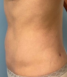 Tummy Tuck After Photo by Julia Spears, MD, FACS; ,  - Case 50320