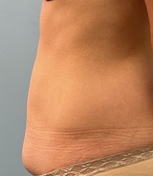 Tummy Tuck Before Photo by Julia Spears, MD, FACS; ,  - Case 50320