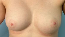 Breast Augmentation After Photo by Julia Spears, MD, FACS; ,  - Case 50321