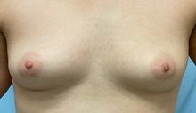 Breast Augmentation Before Photo by Julia Spears, MD, FACS; ,  - Case 50321
