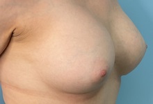 Breast Augmentation After Photo by Julia Spears, MD, FACS; ,  - Case 50321