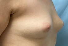 Breast Augmentation Before Photo by Julia Spears, MD, FACS; ,  - Case 50321