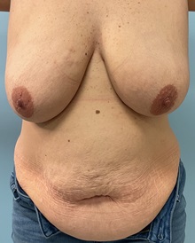 Breast Reduction Before Photo by Julia Spears, MD, FACS; ,  - Case 50327