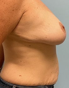 Breast Reduction After Photo by Julia Spears, MD, FACS; ,  - Case 50327