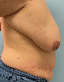 Breast Reduction Before Photo by Julia Spears, MD, FACS; ,  - Case 50327