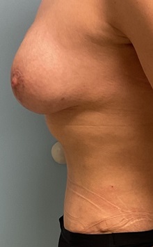 Breast Augmentation After Photo by Julia Spears, MD, FACS; ,  - Case 50332